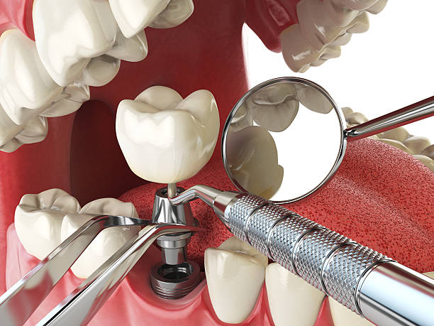Best Broken or Chipped Tooth Repair in Gordo, AL